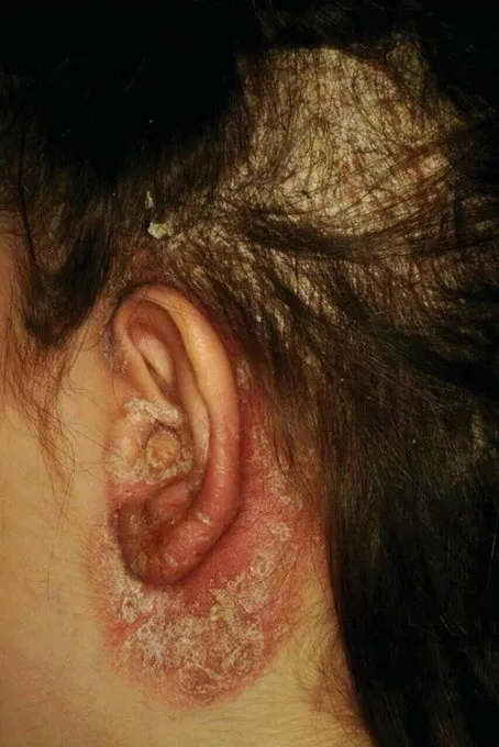 Sedef1 SEDEF HASTALIĞI (Psoriasis)